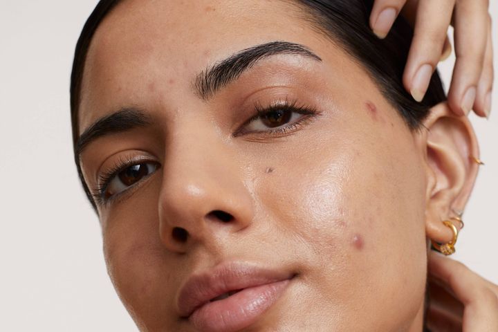 Woman with acne-prone skin and active breakouts