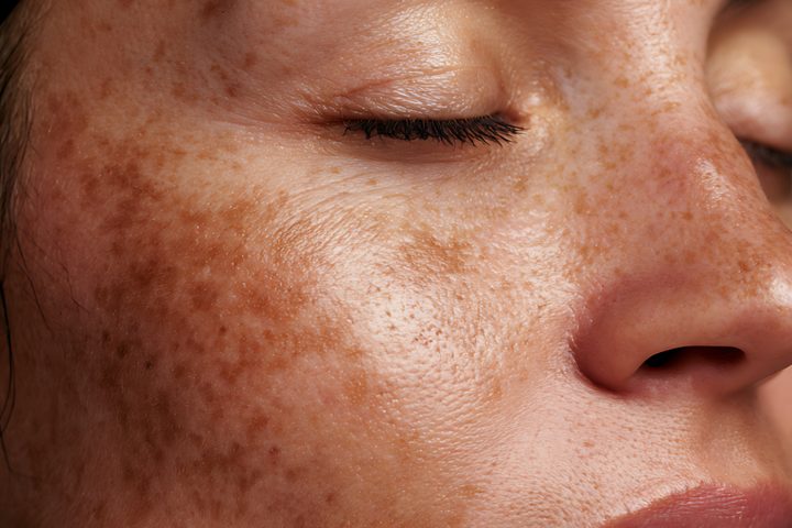 Close-up of a woman’s cheek with brown melasma patches