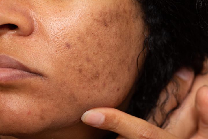 Close-up of a cheek with dark marks and uneven skin tone